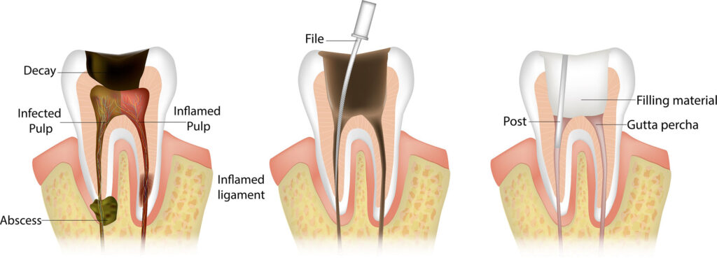 root canals root canal therapy treatment Oak Hollow Dentistry dentist in Draper Utah