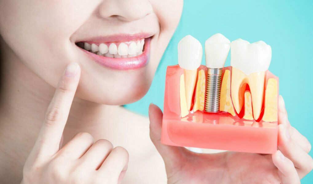 Best Dental Implants in Draper, UT dental implants dental implant Oak Hollow Dentistry dentist in Draper Utah